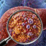 Мастният черен дроб може да се лекува без промяна в храненето